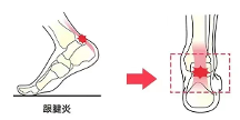 足部問題莫忽視跟腱炎，愛矯健科學(xué)干預(yù)促進健康