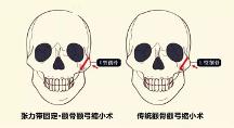 聯(lián)合麗格第 一醫(yī)院何照華院長(zhǎng)：張力帶固定顴骨內(nèi)推與傳統(tǒng)顴骨手術(shù)有何區(qū)別？
