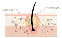 青春期臉上長白色的小痘痘怎么辦？米迪豆專業(yè)祛痘值得信賴！