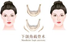 聯(lián)合麗格第 一醫(yī)院何照華院長：想做下頜角手術(shù)，該選哪種術(shù)式？