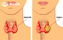烯旺石墨烯醫(yī)療新發(fā)現(xiàn)：用于探索甲狀腺結節(jié)治療新方法效果顯著